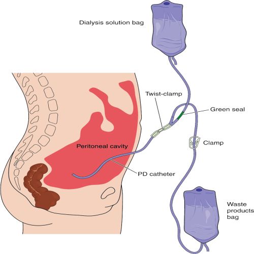 CAPD catheter insertion