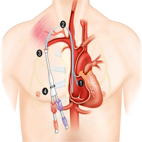 Permcath and CAPD catheter Insertion