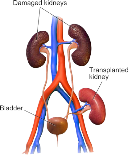 Renal transplant rejection and failure