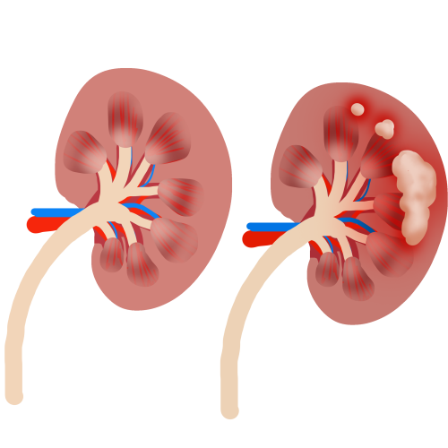 kidney disease in cancer